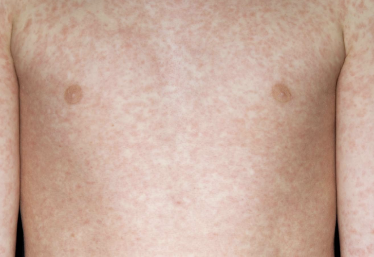 Two Children Die from Measles Amid Rising Cases