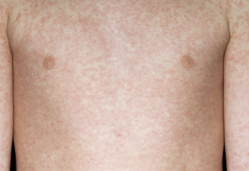 Two Children Die from Measles Amid Rising Cases